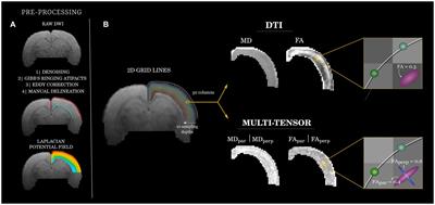 Multi-tensor diffusion abnormalities of gray matter in an animal model of cortical dysplasia